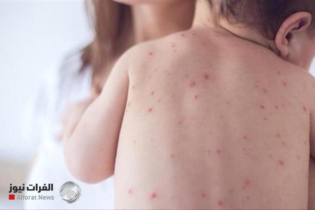 الحصبة تعود من جديد وتغزو الولايات المتحدة