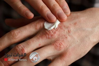 نظام غذائي متوسطي يُحسن أعراض الصدفية بنسبة 75%