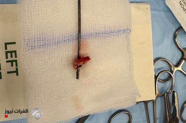 بالصور.. فريق طبي عراقي ينجح في استئصال {شيش} اخترق دماغ شاب