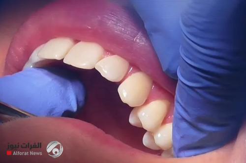 علماء يطورون هلاما لإصلاح الأسنان التالفة دون جراحة