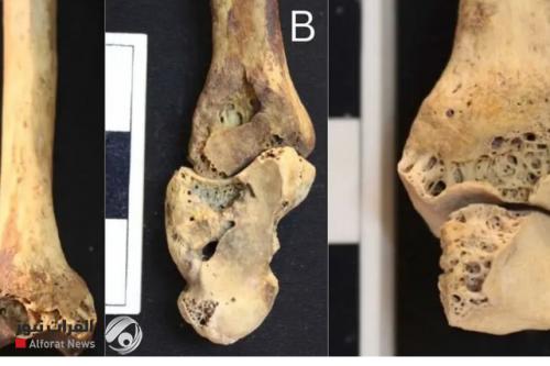الاثار تعلق على اكتشاف أقدم حالة التهاب مفصلي روماتويدي في مصر
